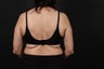 56 year old female, bra line back lift
