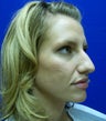 Rhinoplasty