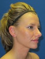 Rhinoplasty