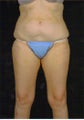 Liposuction
