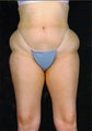 Liposuction