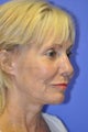 Woman, laser resurfacing procedure