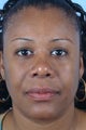 35 Year-Old-Woman Desires a Thinner Nose