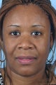 35 Year-Old-Woman Desires a Thinner Nose