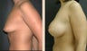 Breast Augmentation