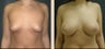 Breast Augmentation