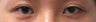 Revision Bilateral Asian Eyelid Surgery