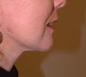 Facelift, Minilift