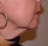 Facelift, Minilift