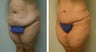Tummy Tuck 