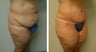 Tummy Tuck 