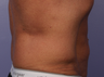 CoolSculpting by Zeltiq to Love Handles/Flanks