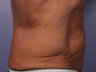 CoolSculpting by Zeltiq to Love Handles/Flanks