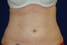 38 year old femail treated upper and lower abdomen