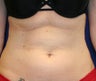 38 year old femail treated upper and lower abdomen
