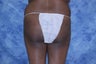 Brazilian Butt Lift