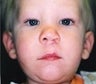 Infant who underwent surgery for a cleft lip and palate 