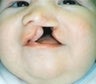 Infant who underwent surgery for a cleft lip and palate 