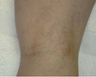 Vein Treatment