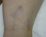 Vein Treatment