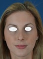 Rhinoplasty