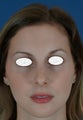 Rhinoplasty