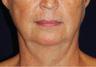 Lower Facial Rejuvenation: Neck Lift