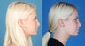 Revision Rhinoplasty - Correction of Alar Malposition, Internal Valve Collapse, Tipplasty