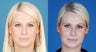 Revision Rhinoplasty - Correction of Alar Malposition, Internal Valve Collapse, Tipplasty