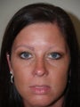 Eyebrow Hair Transplant