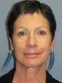 Brow Lift on 58-year-old