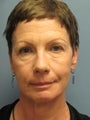 Brow Lift on 58-year-old