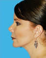 Facelift
