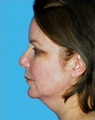 Facelift