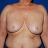 Breast Reduction