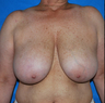 Breast Reduction