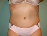 Tummy Tuck