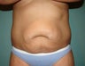 Tummy Tuck
