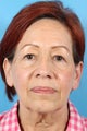 Eyelid Surgery