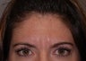 Botox to glabella