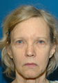 Browlift with left ptosis repair
