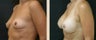 Breast Augmentation