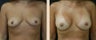 Breast Augmentation