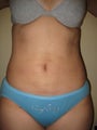 Smart Lipo