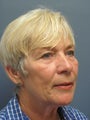 Fat Transfer on 68-year-old