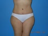 Tummy Tuck