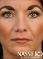 Female Revision Rhinoplasty 