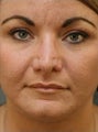 Female Revision Rhinoplasty 