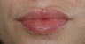 Lip Augmentation