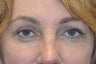 Browlift w hairline lowering, Upper eye blepharoplasty, Lower eyelid skin pinch, Fat transfer